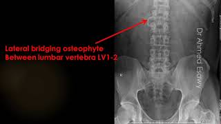 case 604 Lateral bridging osteophyte [upl. by Horsey]