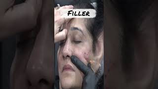 Filler Masterclass  Facial Aesthetics Training  Dr Akshay Bagade facialist shorts [upl. by Silado]