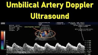 Umbilical Artery Doppler Ultrasound Interpretation  Doppler Ultrasound in Fetal Growth Assessment [upl. by Yelekreb]