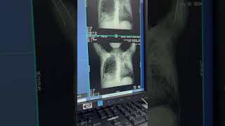 HRCT LUNGS SCANNING 🫁 [upl. by Paten]