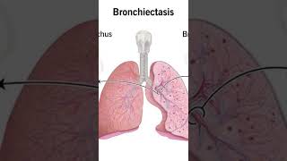 Bronchiectasis neetpg respiration medicine [upl. by Aneeb]