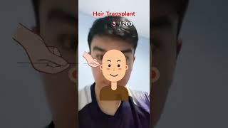 Hair transplant stickman animation [upl. by Justinian]