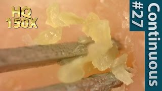 27 Continuous Removal of Blackheads Close up  Squeezing Blackheads [upl. by Hgielak]