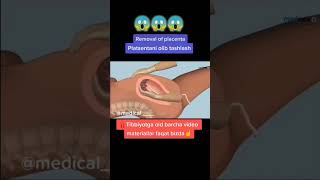 Removal of placenta اكسبلور دويتو ترند elhefnawyclinic تيكتوك shorts [upl. by Ynna90]