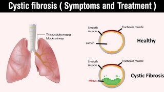 Cystic fibrosis  gene mutation  symptoms and treatment of cystic fibrosis  in Hindi [upl. by Anema]