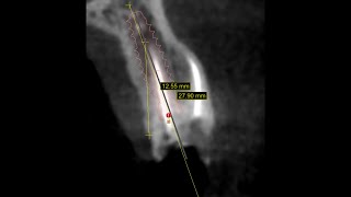 Atraumatic extraction  Immediate implant placement  upper first premolar [upl. by Quint]