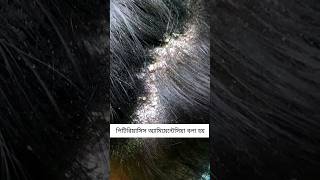 Pityriasis amiantacea 🔥 skincare haircare dandruff psoriasis [upl. by Roshelle]