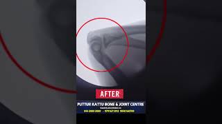 ELBOW DISLOCATION TREATMENT  முழங்கை மூட்டு விலகல்  VADAPALANI  PUTTUR KATTU [upl. by Loyce944]