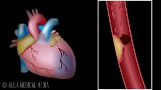 Myocardial Infarction and Coronary Angioplasty Treatment Animation [upl. by Annala717]