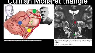 Hypertrophic Olivary degeneration [upl. by Lora733]