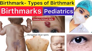 Pediatrics  Birthmarks  Types of Birthmarks  Stroke Spot  Milia Spot  Strawberry Spot  Pedia [upl. by Anned]