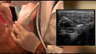 Prolotherapy of the shoulder by Dr Harry Adelson [upl. by Tnahsarp844]