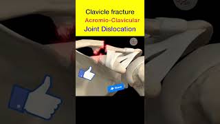 Clavicle fracture amp acromio clavicular joint dislocation shorts clavicle medicalanimation [upl. by Kotto]