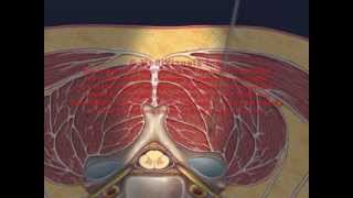 Cervical Interlaminar Epidural Injection Animation [upl. by Oluas257]