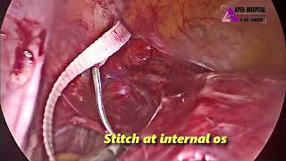 Laparoscopic Abdominal Cerclage by Dr R K Mehta  Apex Hospital Sirsa [upl. by Alinoel240]