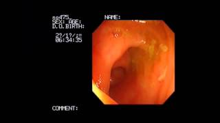 Crohn ulcers in terminal ileum normal colon [upl. by Nylidnarb]