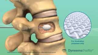 Cement Vertebroplasty  Medical Animation by Watermark [upl. by Cord]