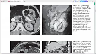 Peritoneum mesentery and abdominal wall imaging [upl. by Eeslek]