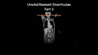 Urachal RemnantDiverticulum Part 3 radiology radiologist embryology urinarybladder [upl. by Dodds]