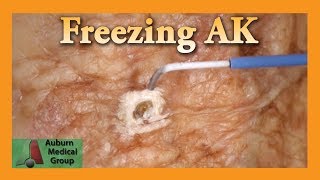 Freezing Hand Actinic Keratosis with Liquid Nitrogen  Auburn Medical Group [upl. by Siberson]