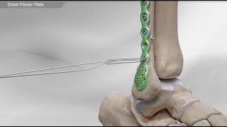 Distal Fibular Plate [upl. by Eugeniusz]