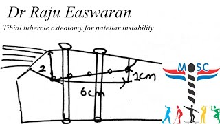 Tibial tubercle osteotomy TTO [upl. by Maurise]