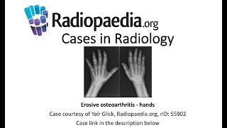 Erosive osteoarthritis Radiopaediaorg Cases in Radiology [upl. by Nagaer]