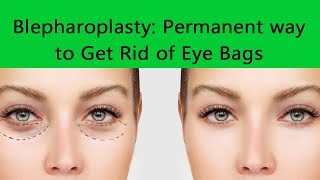 Get Rid of Bags Under Eyes  Blepharoplasty Treatment  The Esthetic Clinics India [upl. by Euginimod944]