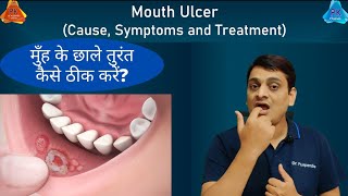 Mouth Ulcer  Treatment for Immediate Relief By Dr Puspendra [upl. by Ennirac]