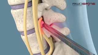 Fullendoscopic spinal treatment of herniated discs and spinal canal stenosis [upl. by Aketahs59]