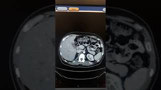 live hemangioma ct [upl. by Ralston]