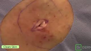 How to removal blackhead 2019 [upl. by Lahsiv]