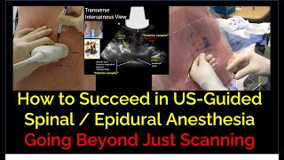 Keys to Success in USGuided Spinal  Epidural Anesthesia  Beyond Just Scanning [upl. by Damiani]