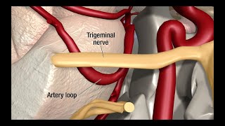 Treatment for Trigeminal Neuralgia UCSF Neurosurgery [upl. by Seigler]