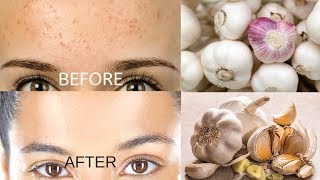 Remove Forehead Pimples Overnight  Acne Treatment with Garlic [upl. by Edelman]