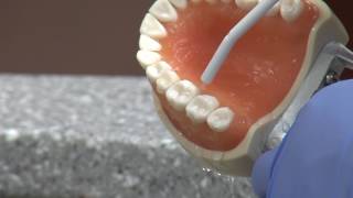 New cavity treatment offers no drilling no filling [upl. by Barnes199]