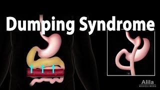 Dumping Syndrome Animation [upl. by Nuahsyt]