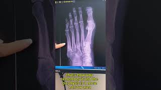 Jones Fracture  Diagnosis and Treatment [upl. by Haimes414]