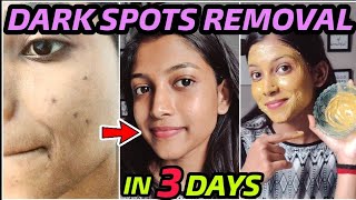 Remove DARK SPOTS NATURALLY in 3 Days 😍 Hyperpigmentation Acne Scars Brown Spots [upl. by Aikar]