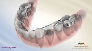 Orthodontic Space Management  Lingual Arch Appliance [upl. by Agnew]