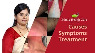 ஆண்களுக்கு ஏற்படும் தோல் நோய் எக்ஸிமாகரப்பான் நோய்அரிப்பு Skin Problem Eczema Karappan Disease [upl. by Jew976]