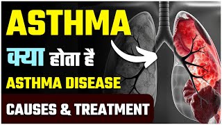 Asthma क्या होता है  Asthma Disease Causes and Treatment  SRIAAS [upl. by Enilrek]