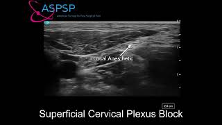 Ultrasound Guided Superficial Cervical Plexus Block [upl. by Oremor]