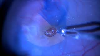 Vitrectomy for Traumatic Macular hole  Dr Manish Nagpal [upl. by Woolcott]