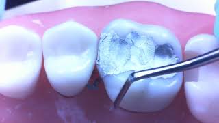 Amalgam Restoration upper molar by Dr Richard g stevenson III [upl. by Retsbew]