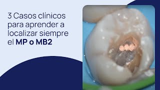 3 Casos clínicos para aprender a localizar siempre el MP o MB2 [upl. by Ryann]