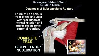 Subscapularis Muscle Tear A Hidden Lesion  Everything You Need To Know  Dr Nabil Ebraheim [upl. by Gurtner]