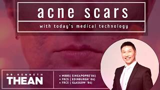 Treatment of Acne Scars  Dr Kenneth Thean [upl. by Max121]