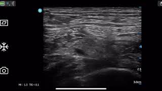 Femoral nerve block by Vscan Air [upl. by Anelrad]