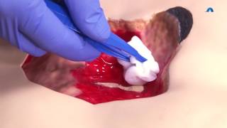 How to Effectively Cleanse and Debride a Wound  Wound Cleansing and Debridement  Ausmed Education [upl. by Lalittah]